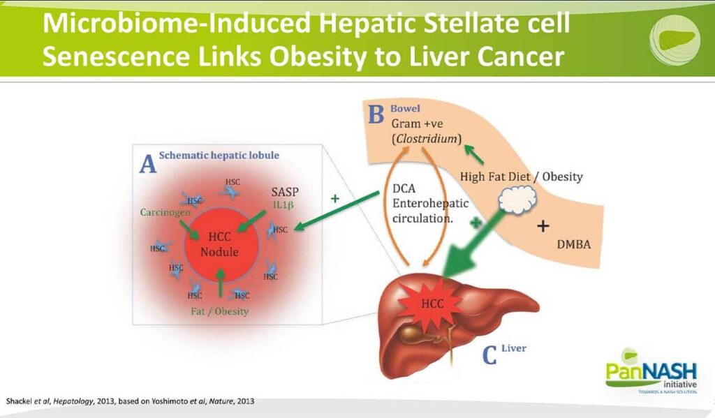 Microbiome-Induced Hepatic Stellate Cell Senescence Links Obesity to Liver Cancer