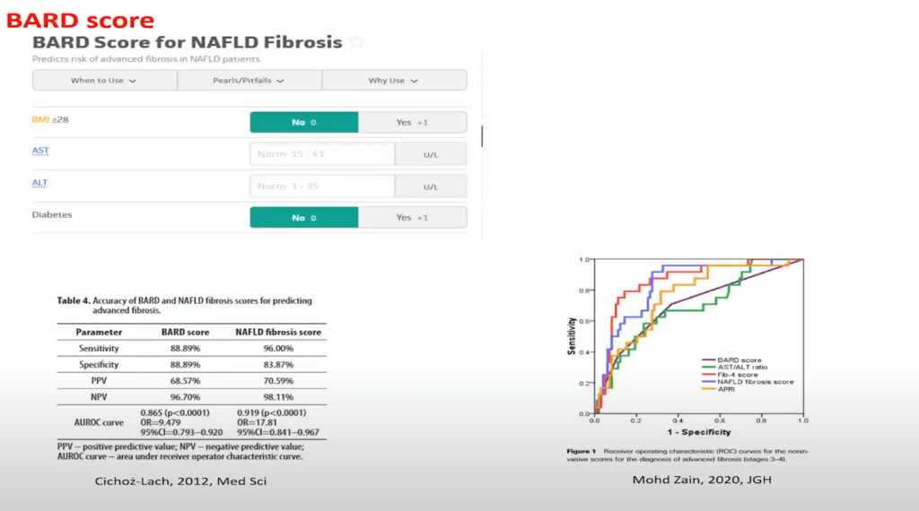 The Viability of the BARD Score in Diagnosing Advanced Fibrosis